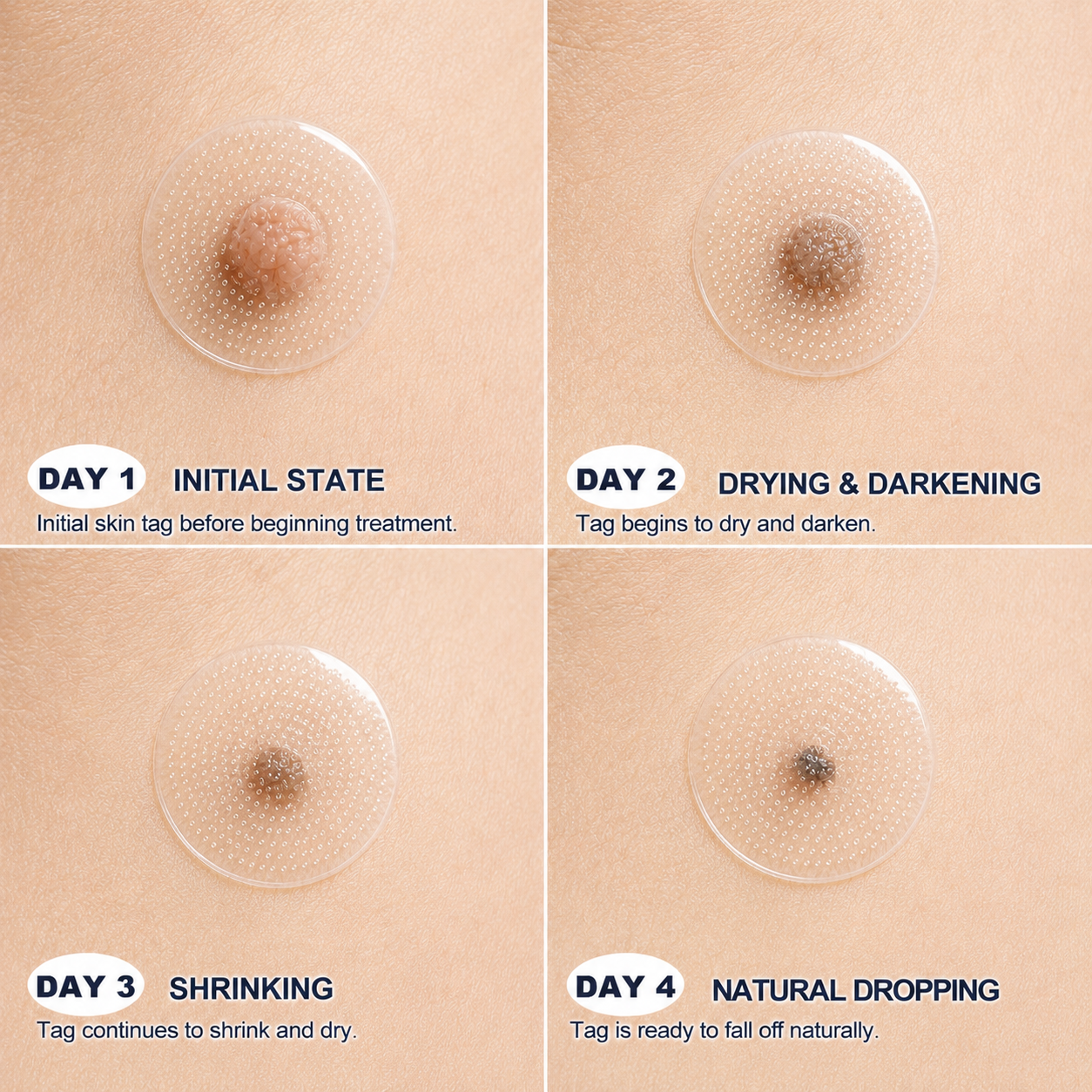💕👩🏻‍⚕️ 𝐎𝐟𝐟𝐢𝐜𝐢𝐚𝐥 𝐒𝐭𝐨𝐫𝐞 | 𝑵𝐞𝒌𝐢𝐬𝐬® 🌿 𝐁𝐨𝐭𝐚𝐧𝐢𝐜𝐚𝐥 𝐌𝐢𝐜𝐫𝐨𝐧𝐞𝐞𝐝𝐥𝐞 𝐇𝐲𝐝𝐫𝐨𝐜𝐨𝐥𝐥𝐨𝐢𝐝 𝐏𝐚𝐭𝐜𝐡 (𝐅𝐨𝐫 𝐒𝐤𝐢𝐧 𝐓𝐚𝐠𝐬, 𝐒𝐦𝐚𝐥𝐥 𝐒𝐤𝐢𝐧 𝐆𝐫𝐨𝐰𝐭𝐡𝐬, 𝐖𝐚𝐫𝐭𝐬, 𝐌𝐨𝐥𝐞𝐬, 𝐀𝐠𝐞 𝐒𝐩𝐨𝐭𝐬 & 𝐏𝐢𝐠𝐦𝐞𝐧𝐭𝐚𝐭𝐢𝐨𝐧 𝐂𝐨𝐧𝐜𝐞𝐫𝐧𝐬)