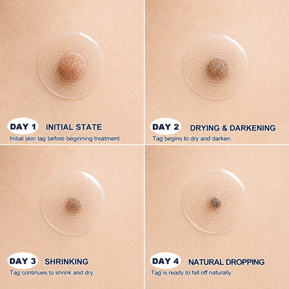 💕👩🏻‍⚕️ 𝐎𝐟𝐟𝐢𝐜𝐢𝐚𝐥 𝐒𝐭𝐨𝐫𝐞 | 𝑵𝐞𝒌𝐢𝐬𝐬® 🌿 𝐁𝐨𝐭𝐚𝐧𝐢𝐜𝐚𝐥 𝐌𝐢𝐜𝐫𝐨𝐧𝐞𝐞𝐝𝐥𝐞 𝐇𝐲𝐝𝐫𝐨𝐜𝐨𝐥𝐥𝐨𝐢𝐝 𝐏𝐚𝐭𝐜𝐡 (𝐅𝐨𝐫 𝐒𝐤𝐢𝐧 𝐓𝐚𝐠𝐬, 𝐒𝐦𝐚𝐥𝐥 𝐒𝐤𝐢𝐧 𝐆𝐫𝐨𝐰𝐭𝐡𝐬, 𝐖𝐚𝐫𝐭𝐬, 𝐌𝐨𝐥𝐞𝐬, 𝐀𝐠𝐞 𝐒𝐩𝐨𝐭𝐬 & 𝐏𝐢𝐠𝐦𝐞𝐧𝐭𝐚𝐭𝐢𝐨𝐧 𝐂𝐨𝐧𝐜𝐞𝐫𝐧𝐬)